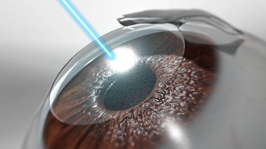 הדמיה של הליך LASIK: מתלה קרנית מורם וקרן לייזר מכוונת אל מיטת הסטרומה